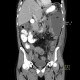 Crohn's disease of small bowel, abdominal abscess: CT - Computed tomography
